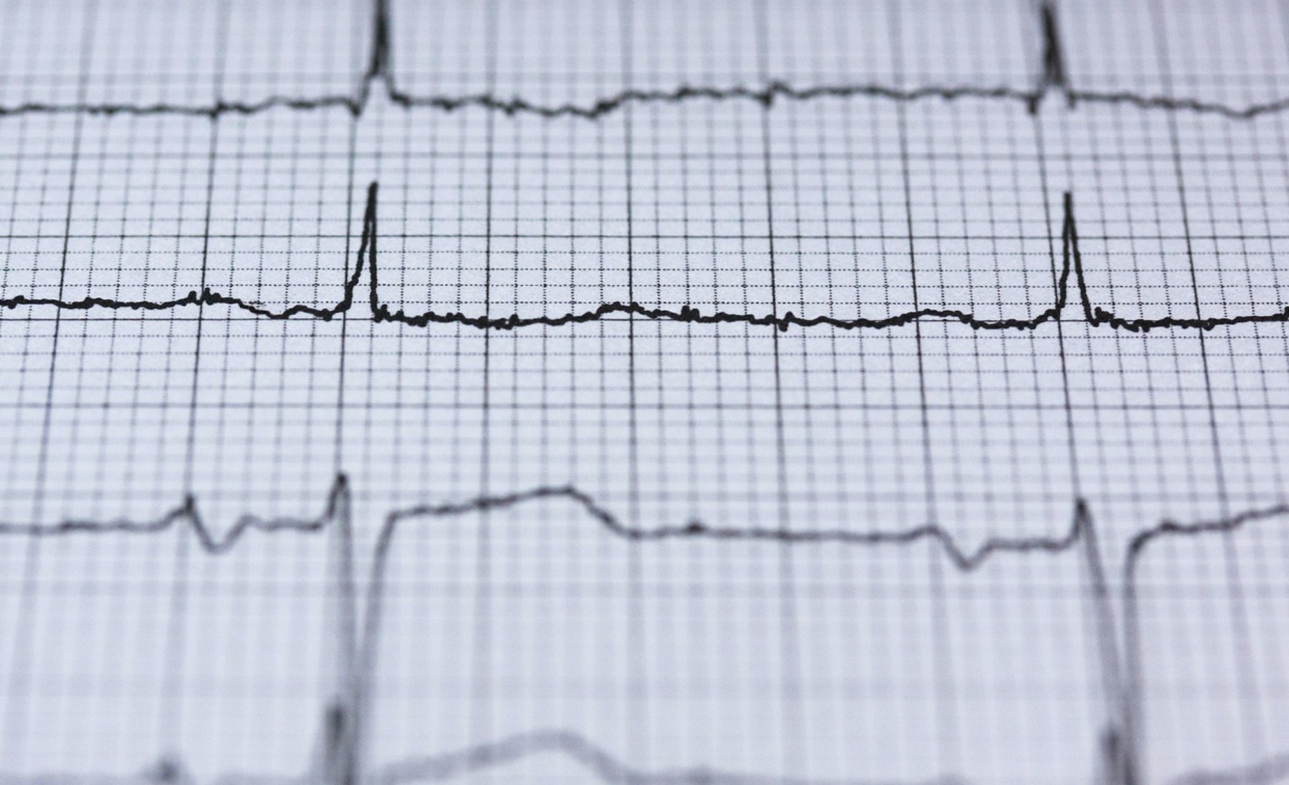 Electrocardiogramme